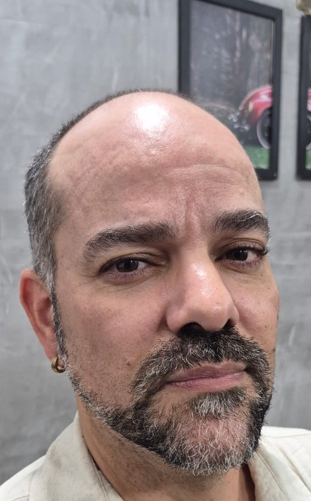 Antes da prótese capilar