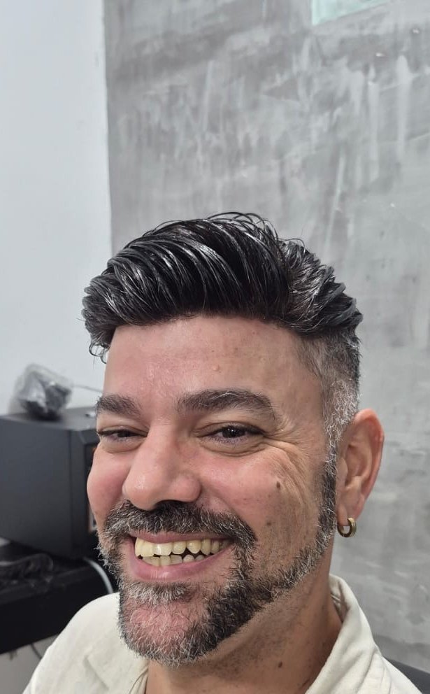Depois da prótese capilar