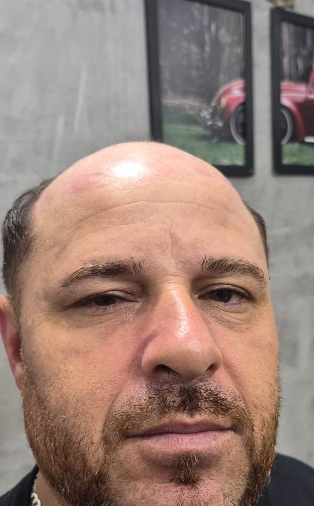 Antes da prótese capilar
