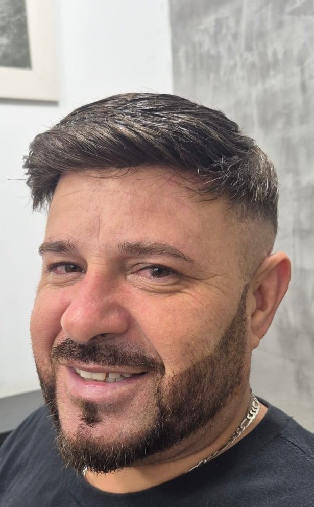 Depois da prótese capilar