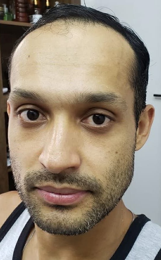 Antes da prótese capilar
