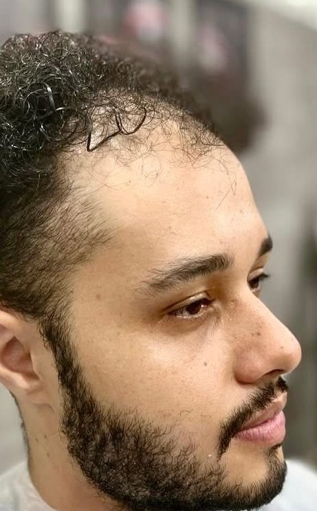 Antes da prótese capilar