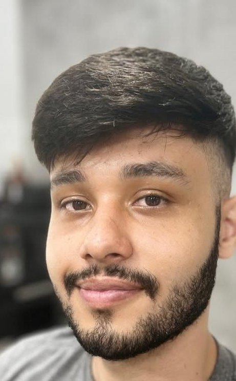 Depois da prótese capilar